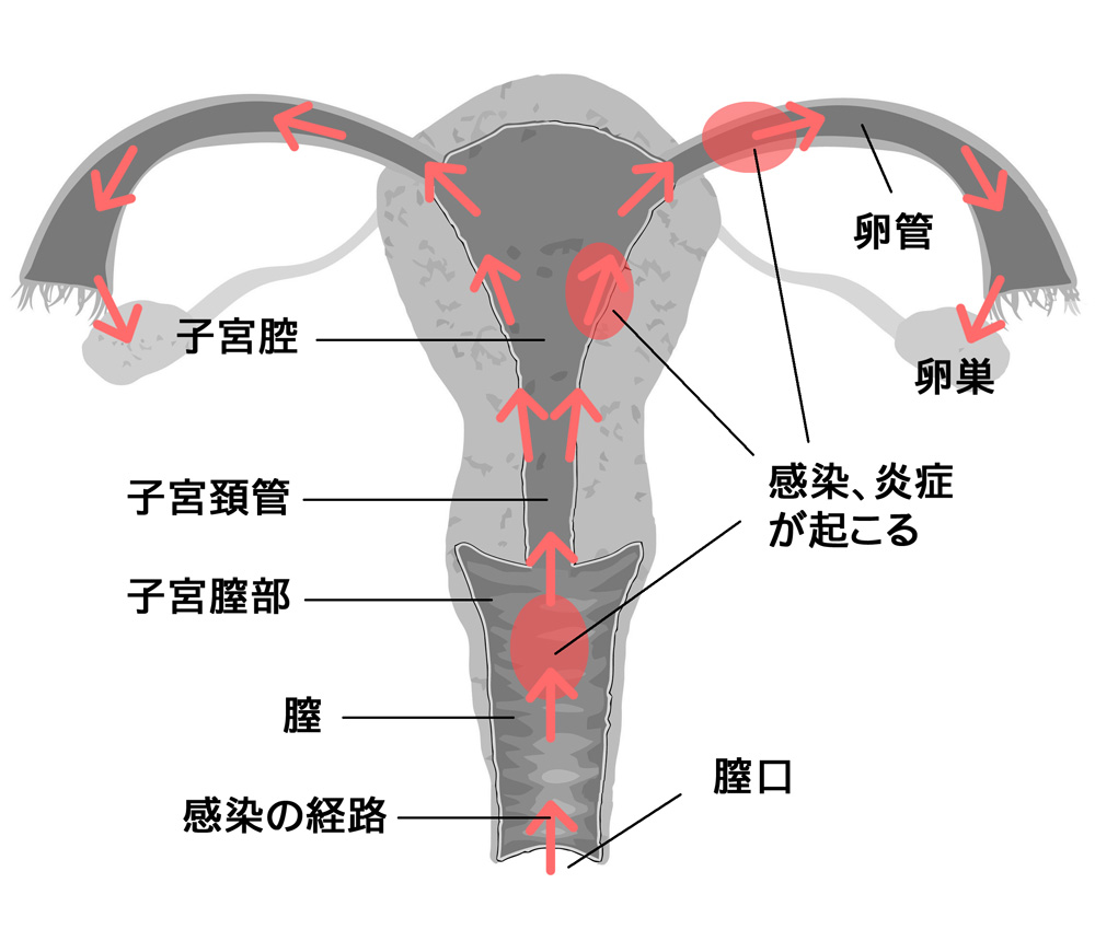 子宮付属器炎の原因菌の流れ